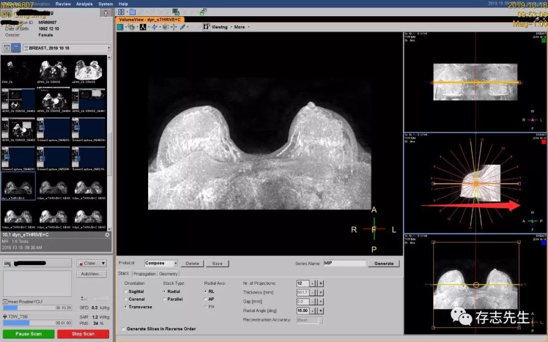 乳腺磁共振亲身经历,磁共振乳腺动态增强扫描全过程
