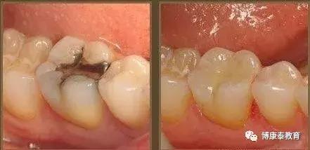 牙齿掉了一半是补牙还是植牙,牙齿烂了为什么不能拔