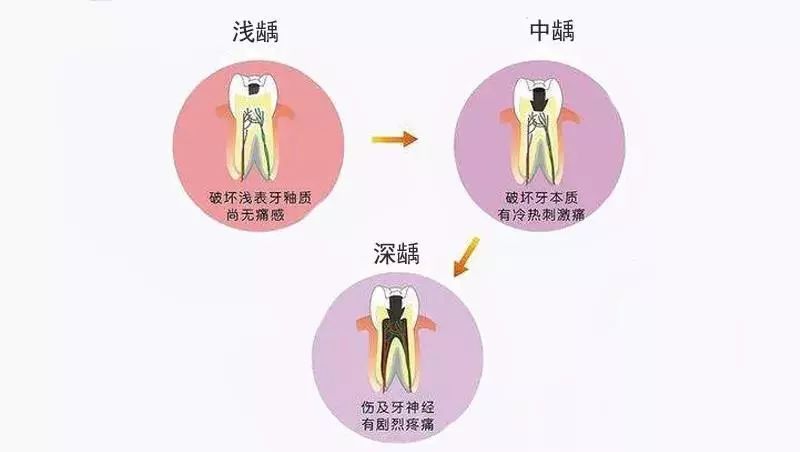 什么是牙髓炎牙髓炎可以自愈吗,什么是牙髓炎要根治吗