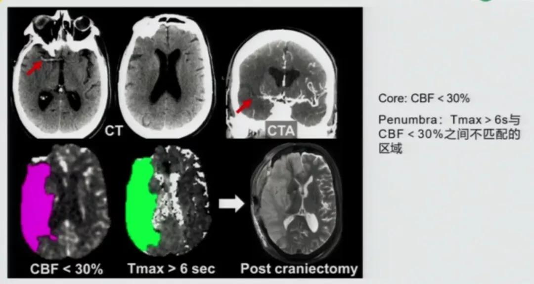 急性脑中风影像诊断选择,急性脑卒中首选哪种检查方法