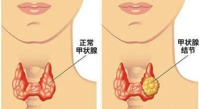 甲状腺结节脖子两侧有突起,甲状腺结节脖子出现红斑是炎症吗