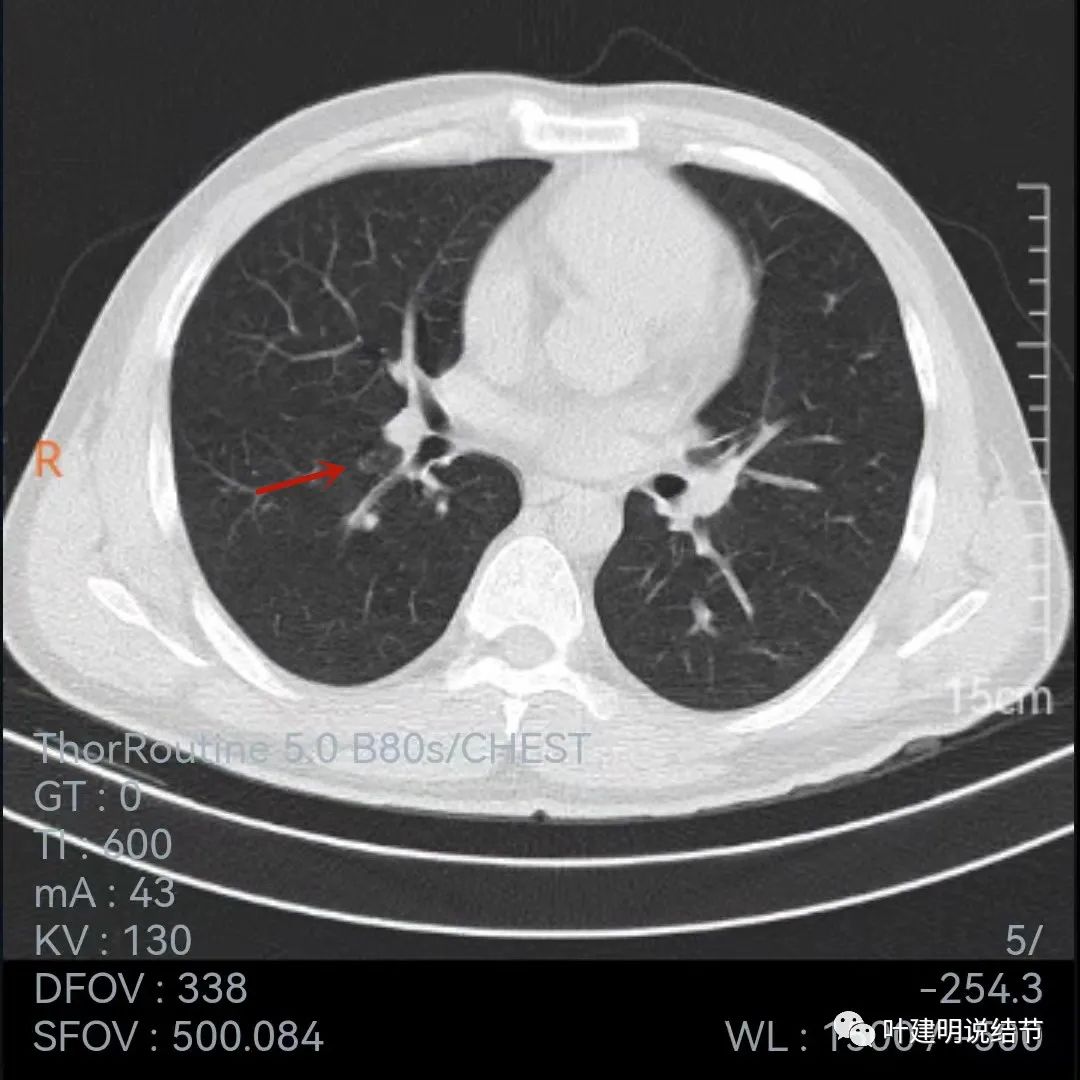 问诊分析：存在了4年的实性结节会不会是肺癌？