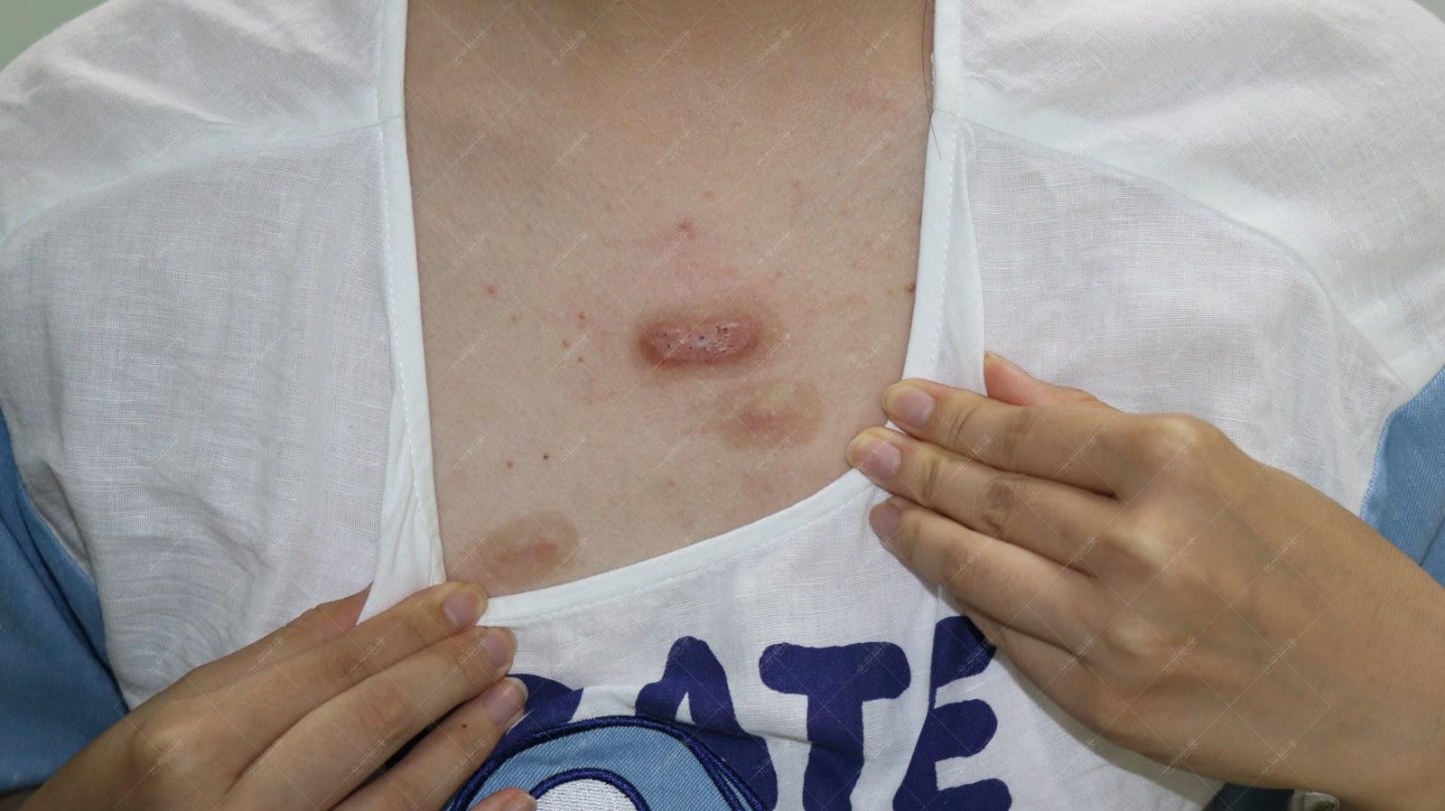 疤康医院治疗疤痕大概多少钱,祛疤灵能去除疤痕吗