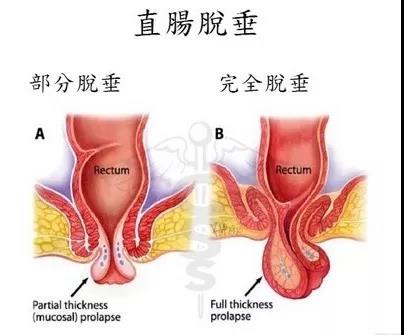 “医生，我肛门整天坠的慌，有便意还拉不出来，是咋回事？”