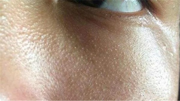 脂肪粒白头怎么去,脂肪粒去除小妙招皮肤
