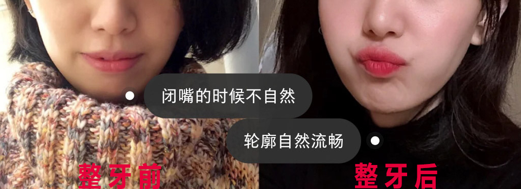 整牙讲解,整牙一定要问的问题