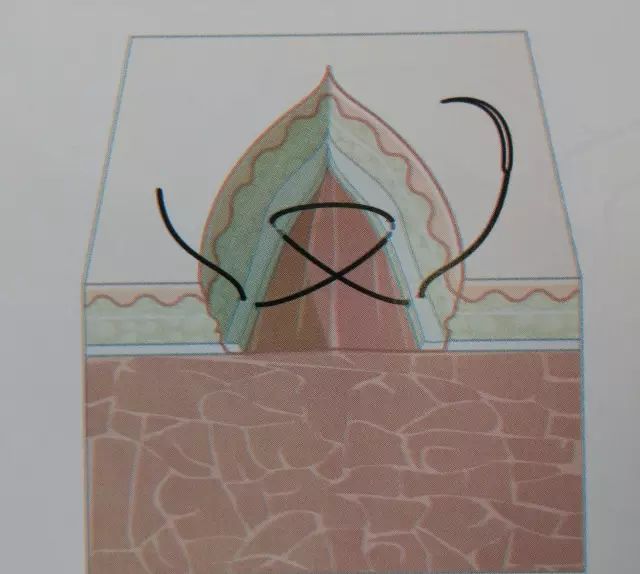 伤口闭合的正确方法,伤口清创的详细步骤