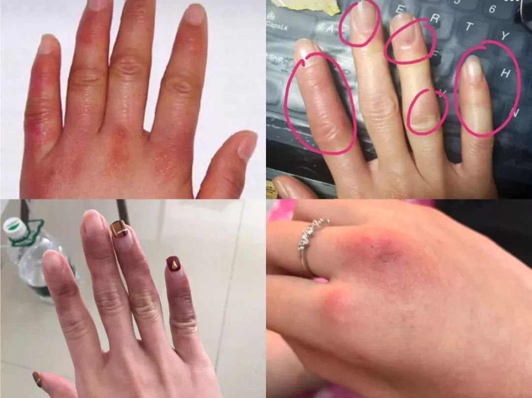 冬天脚后跟干裂用什么润脚霜,润足脚后跟干裂修复霜