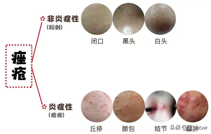 皮肤痘怎么消除,解决皮肤问题对策