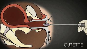 人流最多次案例,20岁女孩人流七次后续