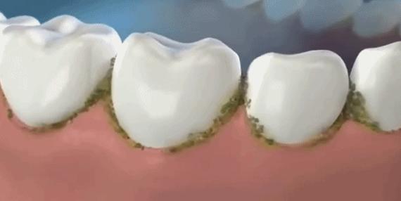 刷牙怎么刷能立刻从黄牙变成白牙,刷牙白牙小妙招