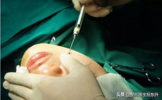 脂肪填充面部减龄部位,面部凹陷脂肪填充演示