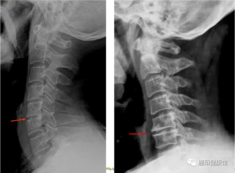 30岁颈椎增生,58岁体检发现颈椎增生怎样治疗