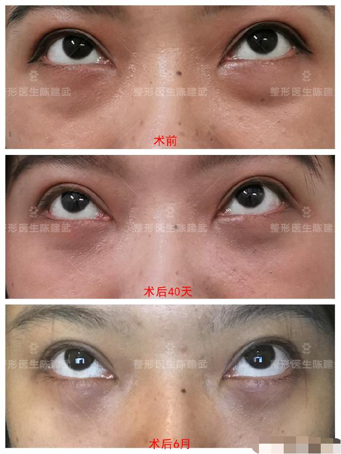 眼袋手术为什么不能侧睡,眼袋手术感觉眼睛闭不上