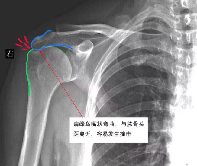 好多人以为是肩周炎其实是颈椎病,肩膀疼痛别总以为是肩周炎