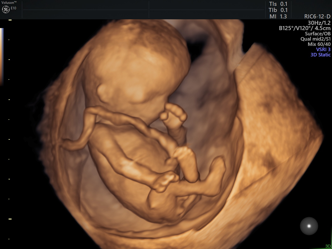 孕期超声,孕期超声一定要做吗