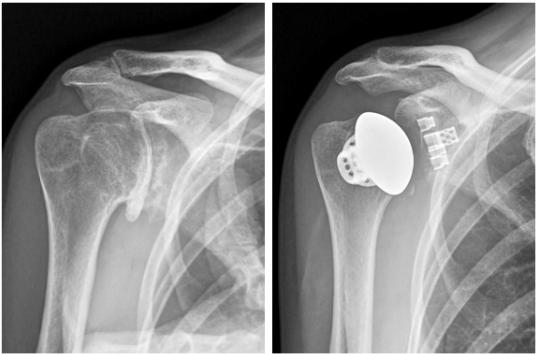 激光3D打印无茎肩关节植入物