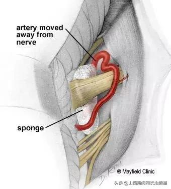 长治市和平医院能做减压手术吗,长治市和平医院动脉介入手术