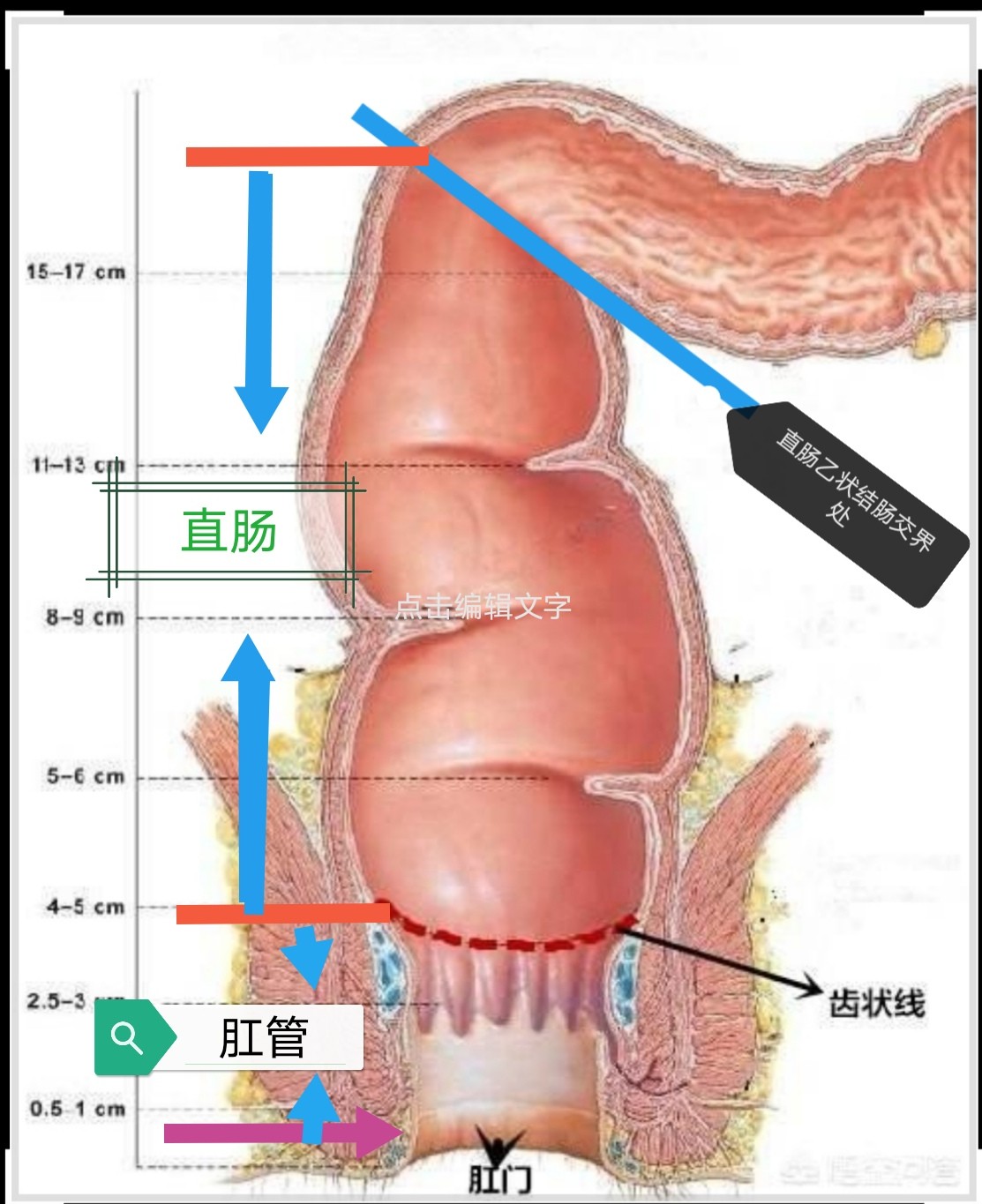 直肠癌术后造瘘口的预见性护理,直肠癌术后吻合口瘘护理措施