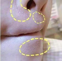 40岁下巴长痘怎么彻底治好,下巴唇下长痘痘的正确消除方法