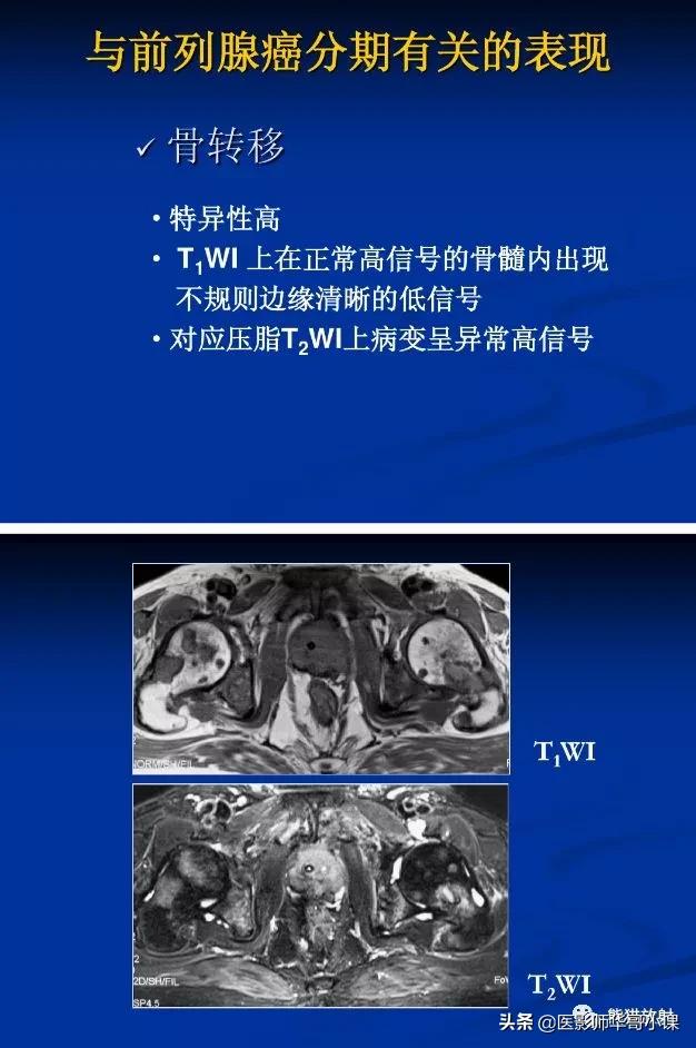 前列腺磁共振影像解剖,前列腺mri正常诊断报告模板