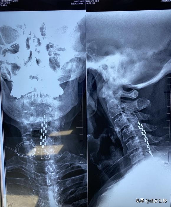 一泵“镇”顽痛！交大一附院鞘内药物输注泵植入术迈进止痛“高速公路”