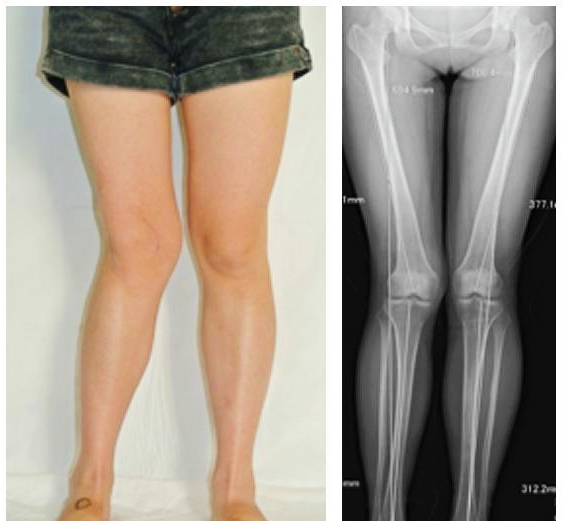 关节炎辟谣,膝关节滑膜炎辟谣