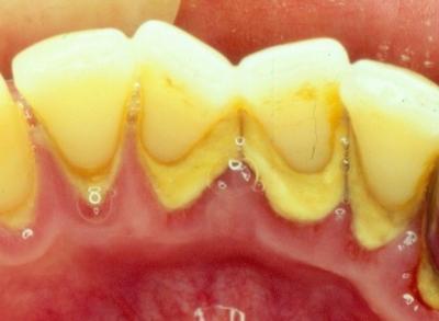 吃了维生素c牙龈出血是什么原因,牙龈经常出血与缺少什么有关