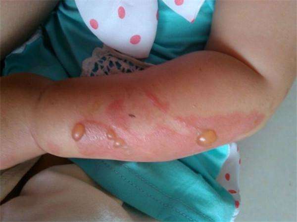 孩子烫伤后最佳治疗时间只有120秒,孩子烫伤恢复过程