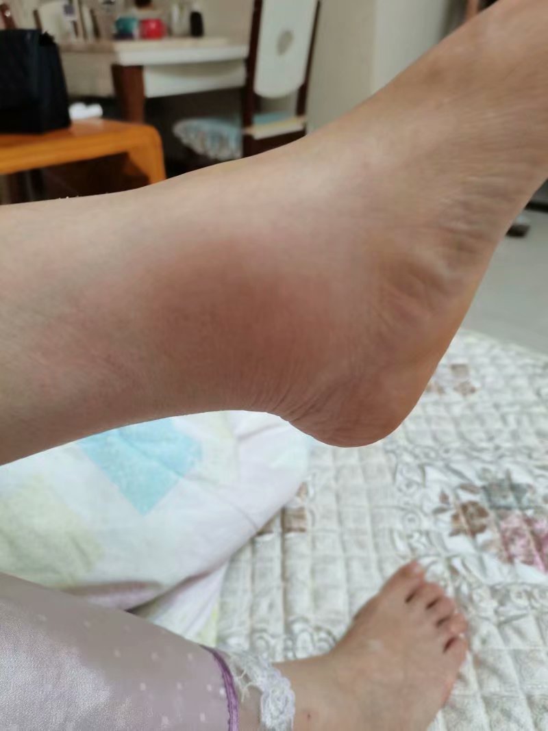 急性脚踝扭伤处理视频,踝关节扭伤的病例分析