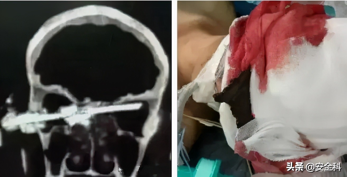 2009年砂轮机破裂伤人事件,砂轮机安全事故案例真实视频