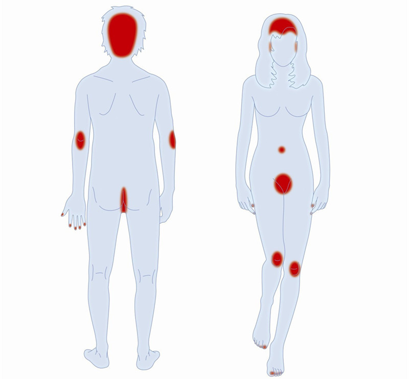 干癣成因,干癣是什么原因