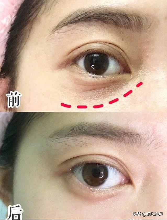 及时补救鱼尾纹的方法,教你一招如何淡化鱼尾纹