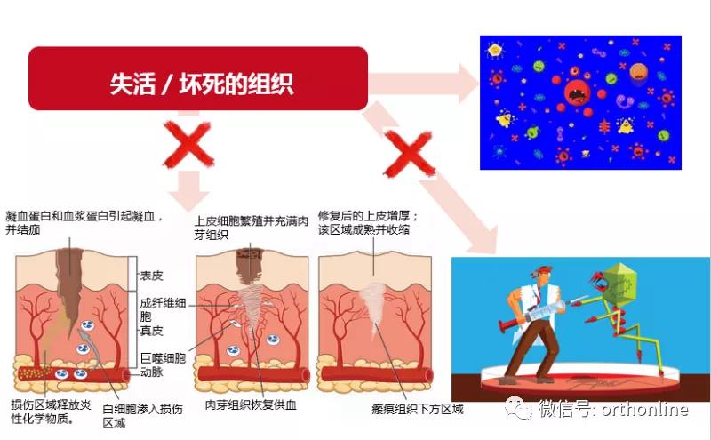 临床清创原则,临床清创