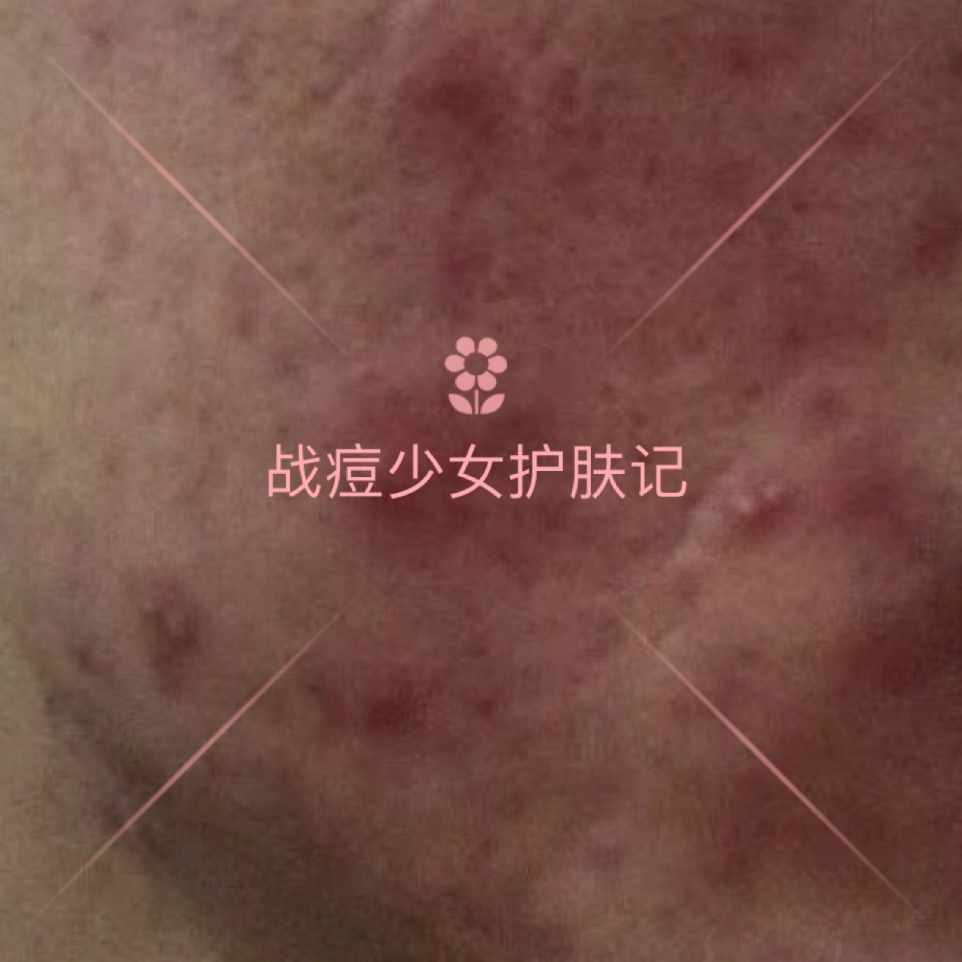 四种痘痘最佳治疗方法,各种痘痘的对症用药