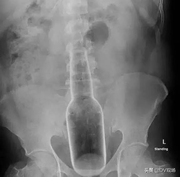 大叔将花露水瓶塞入直肠，一问缘由竟是为了止痒