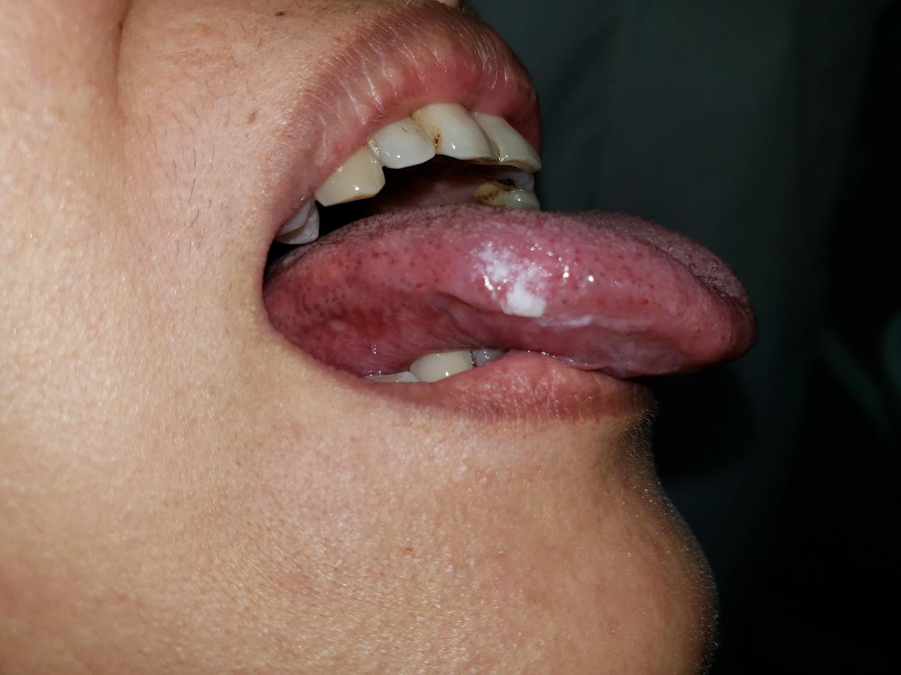 口腔白斑是临床病名吗,口腔白斑是癌前病变吗