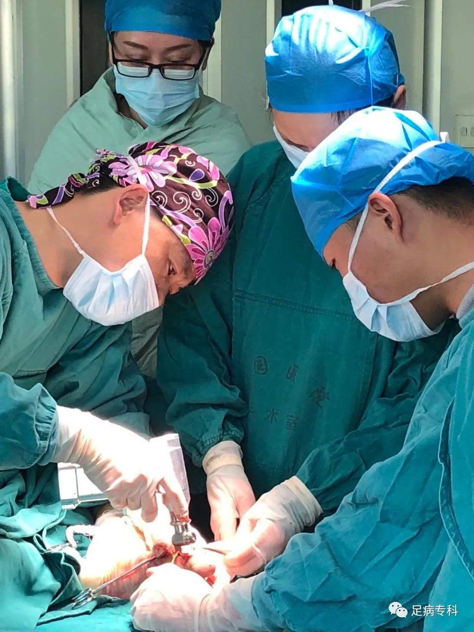 拇外翻微创手术的全过程,医生自己给自己做拇外翻手术