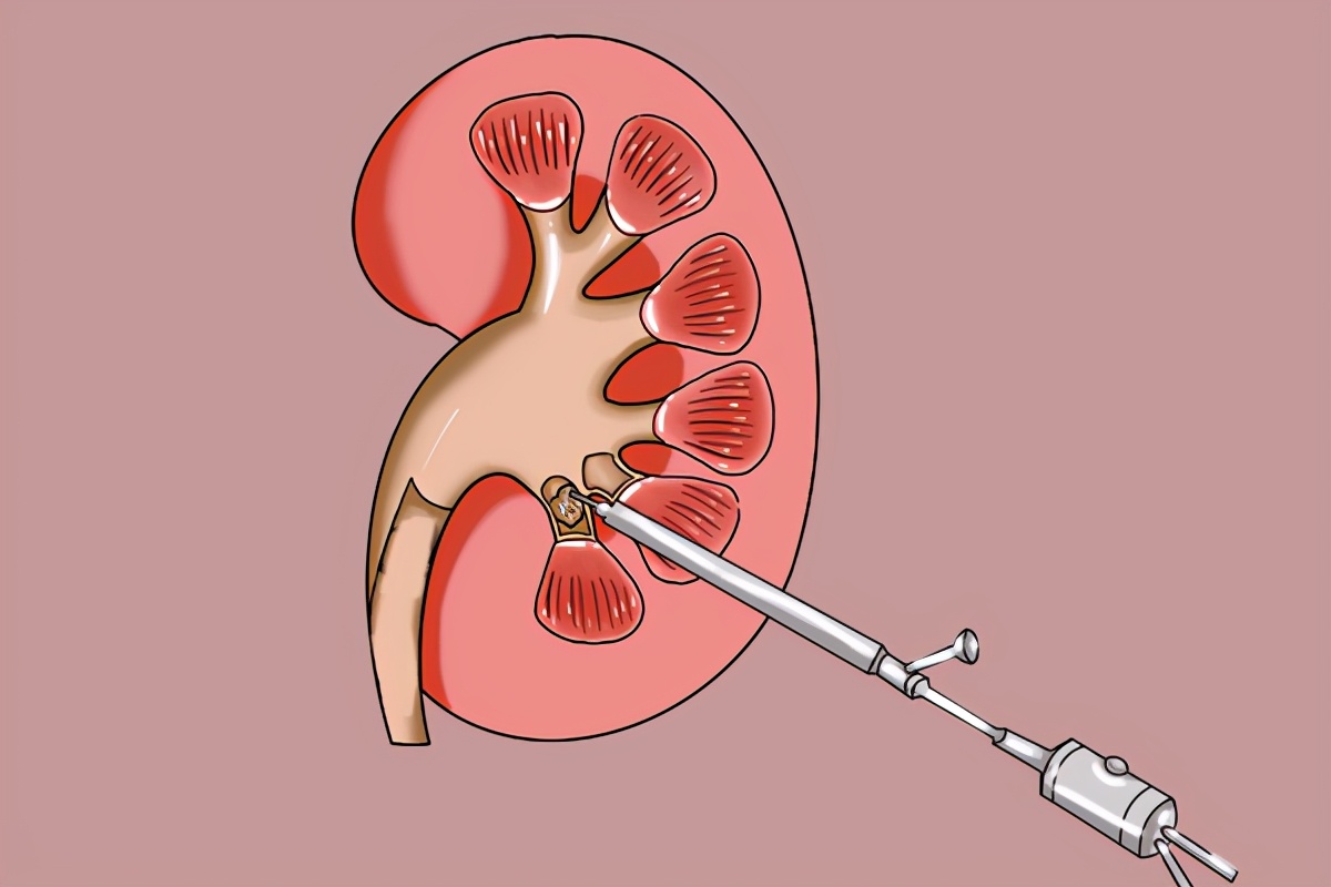 体内有结石多喝水能排出来吗,体内排出的结石