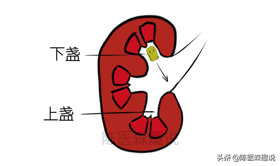 1.5厘米的肾结石保守治疗能排石吗,肾结石快速排石方法