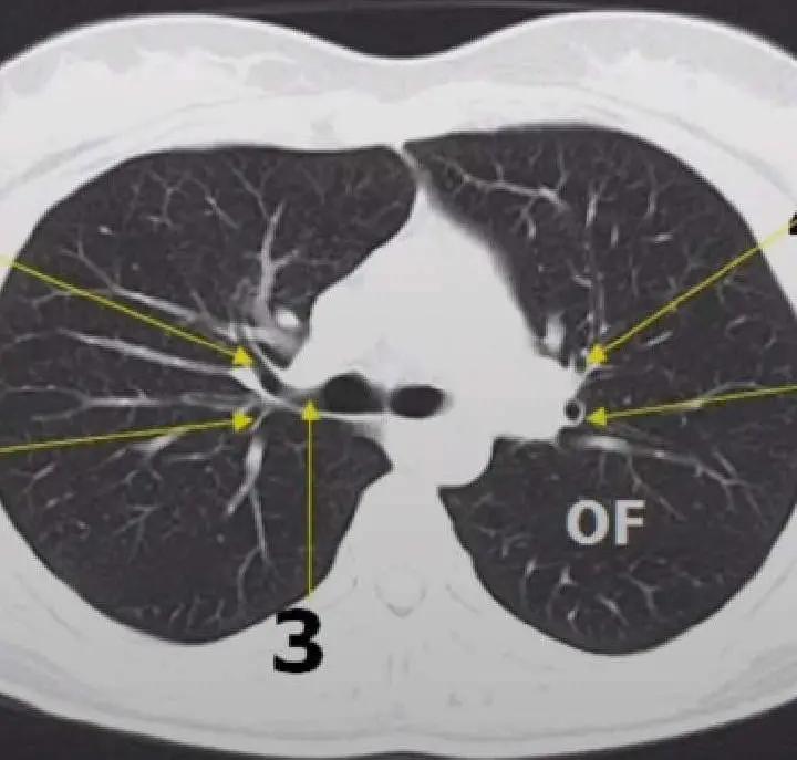 中国第一例肺移植病人,哪个医院能肺移植