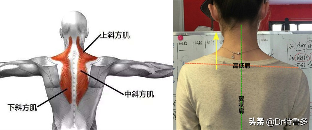 蝴蝶骨不是一种病吗,蝴蝶骨是颈椎病吗
