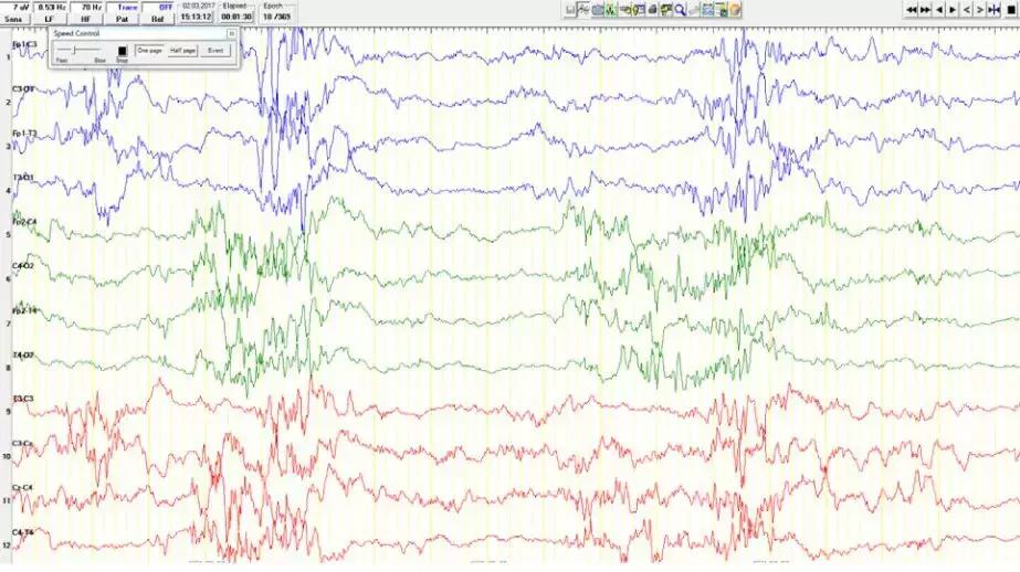 生酮初期症状及治疗方法,生酮饮食的疾病断根方法