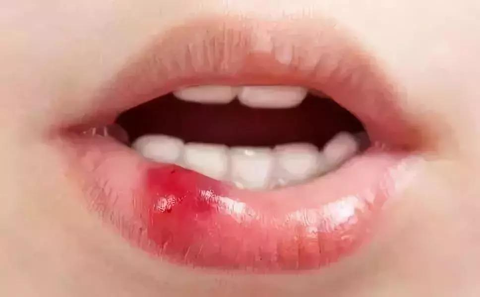 大s去唇干裂小妙招,嘴唇干裂起皮小秘方