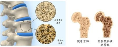 类风湿骨病怎么预防,类风湿病患者日常怎么预防