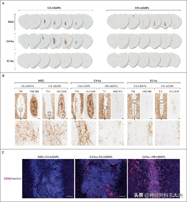日本干细胞移植帕金森能治愈吗,北京干细胞移植治疗帕金森招募