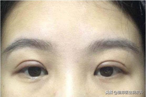 割双眼皮后怎样可以尽快完全恢复,割双眼皮的危害老了以后会怎样