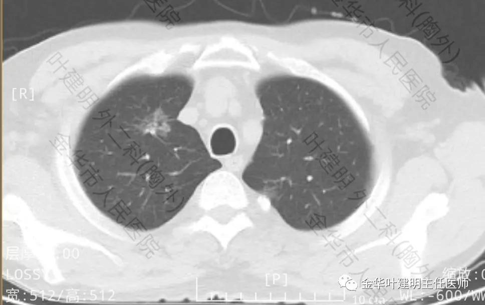 肺多发转移癌主要治疗手段,右肺上叶癌怎么治疗