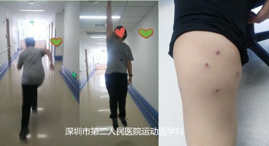 髌骨半脱位关节镜微创手术,髌骨脱位二联手术