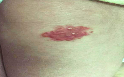 百天宝宝患有血管瘤，激光、敷药该如何抉择？愁坏妈妈